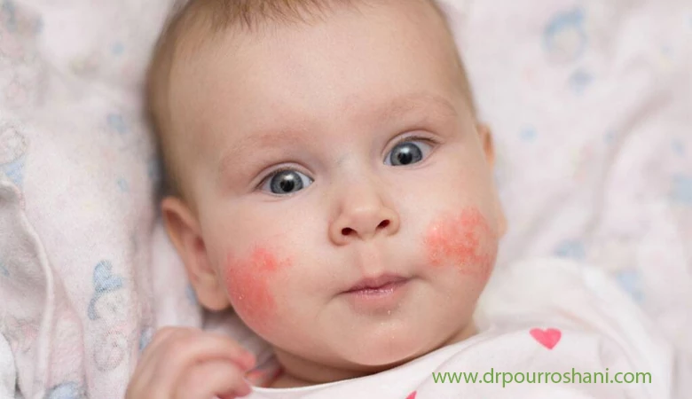آلرژی در کودکان