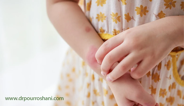 چگونه آلرژی در کودکان را تشخیص داد؟