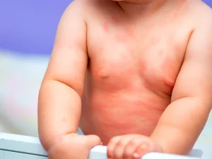 آیا حساسیت به پروتئین گاوی در کودکان خطرناک است؟