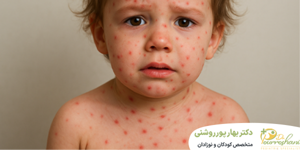 ابله مرغان در کودکان چیست