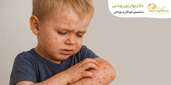 درمان آبله مرغان
