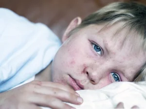 راه های درمان سرخک در کودکان