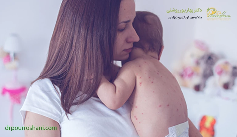 سرخک در کودکان