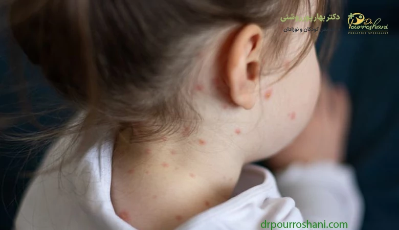 علائم سرخک در کودکان
