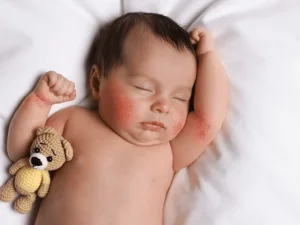 برای درمان حساسیت پوستی نوزادان به چه دکتری مراجعه کنیم؟