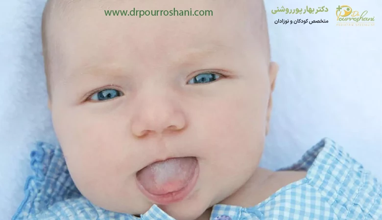 برفک دهان نوزاد چیست؟