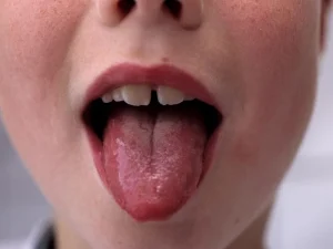 بیماری مخملک در کودکان چیست؟