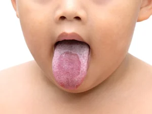 تشخیص برفک دهان نوزاد