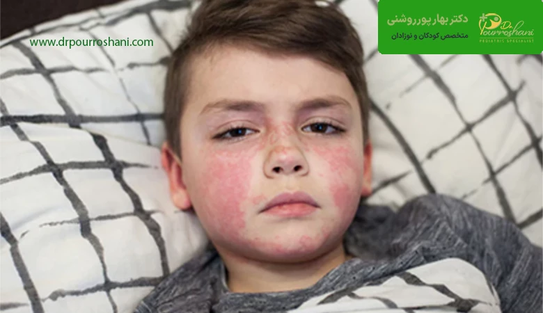 تشخیص بیماری مخملک در کودکان