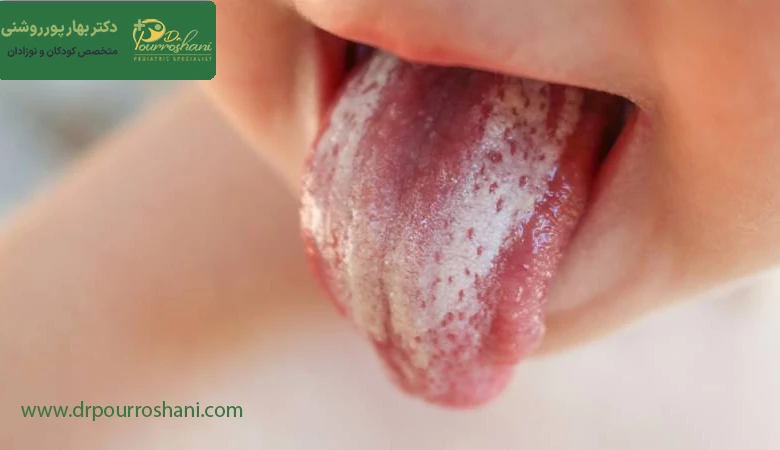 علائم برفک دهان نوزاد