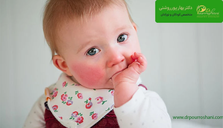 علل بیماری مخملک در کودکان