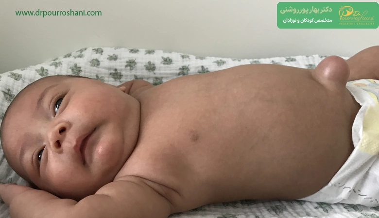 فتق در کودکان چیست؟