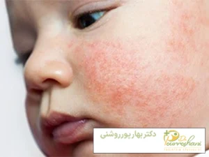 قارچ پوستی کودکان