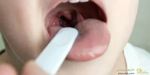 بزرگی لوزه در کودکان