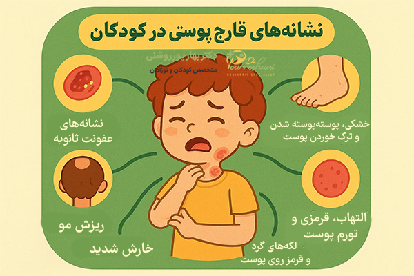 نشانه‌های قارچ پوستی درکودکان