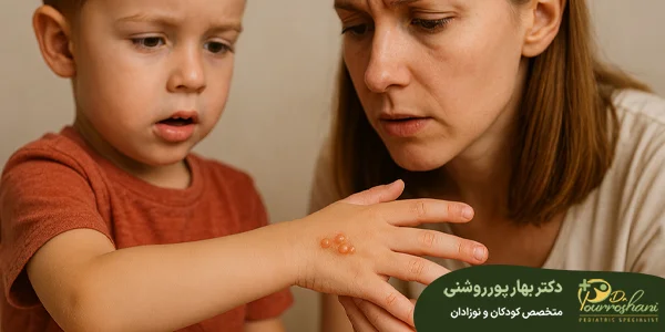 تاول پوستی در کودکان چیست_jpg