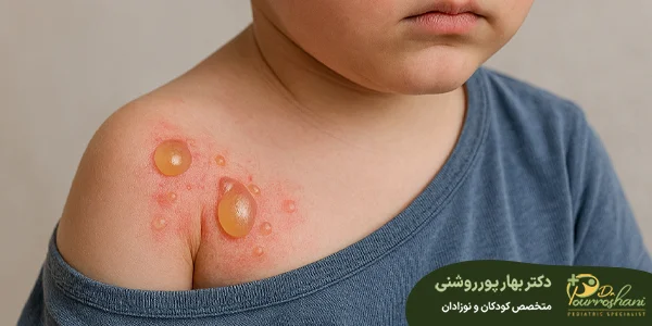 درمان تاول پوستی در کودکان
