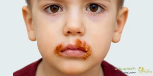 زرد زخم در کودکان