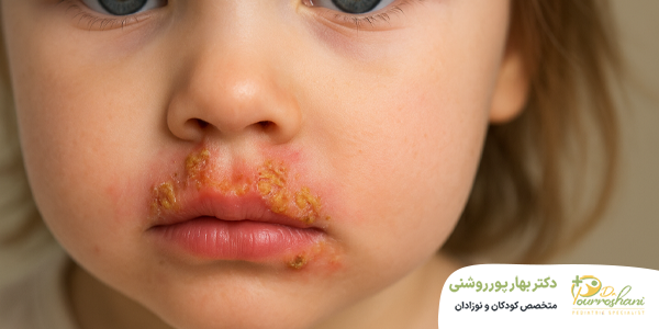 علت ایجاد زرد زخم در کودکان